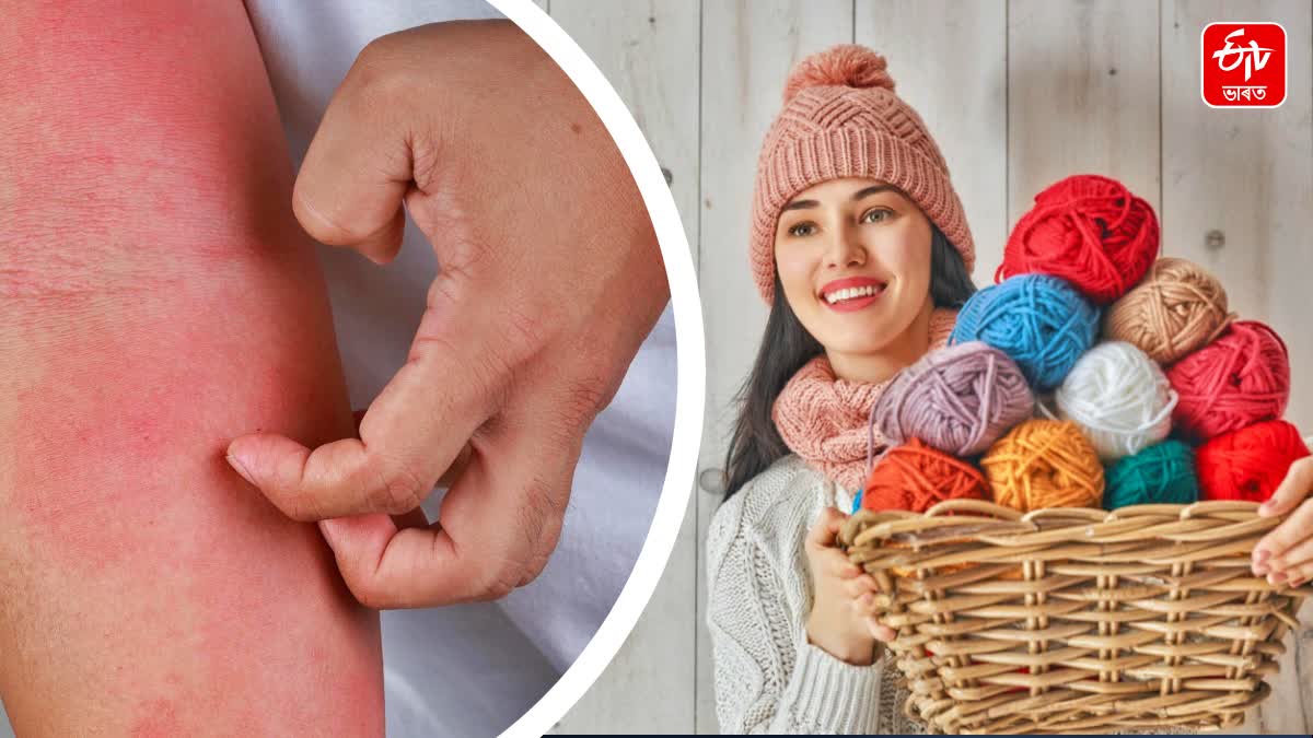 Woolen clothes cause skin rashes and itching? Follow these tips to avoid