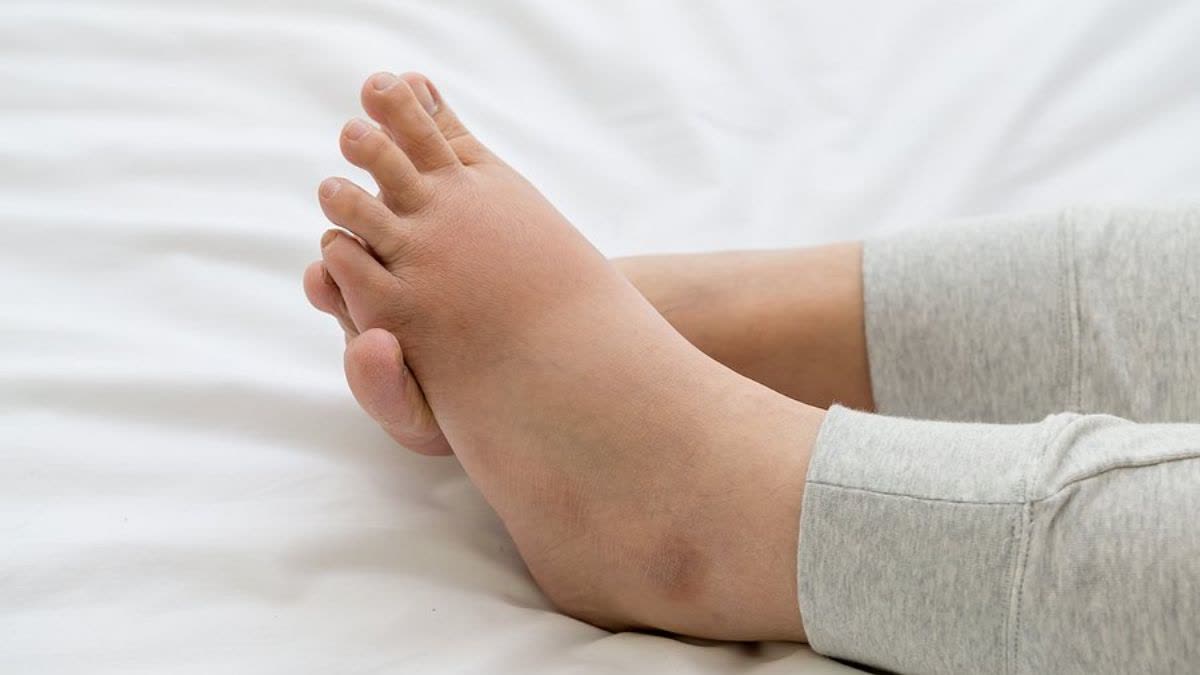 Swelling in toes can increase problems in cold weather