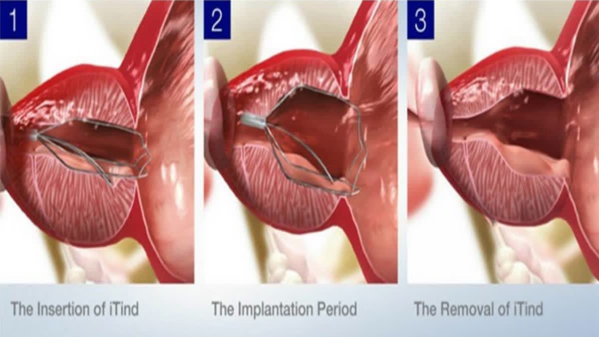 Hyderabad-based AINU Hospital introduces revolutionary iTIND solution for urinary problems