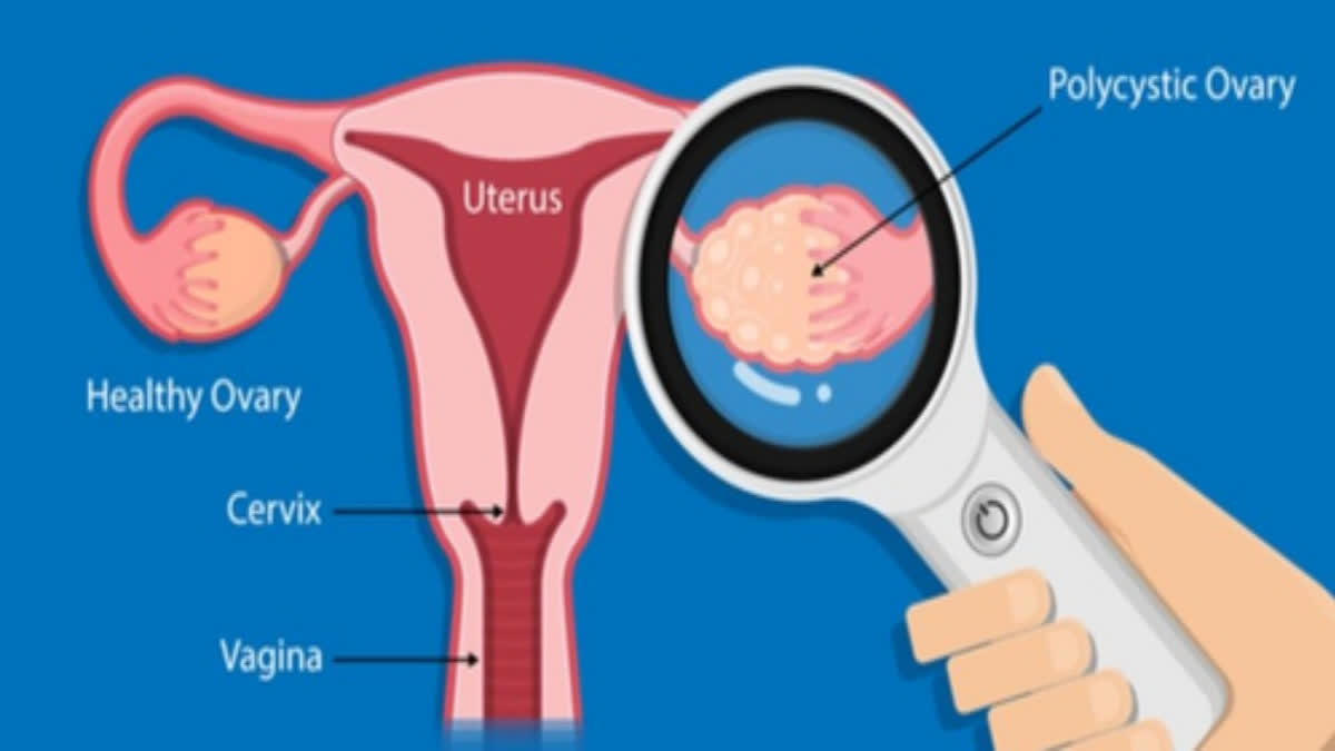 ovarian cancers are diagnosed at a later stage