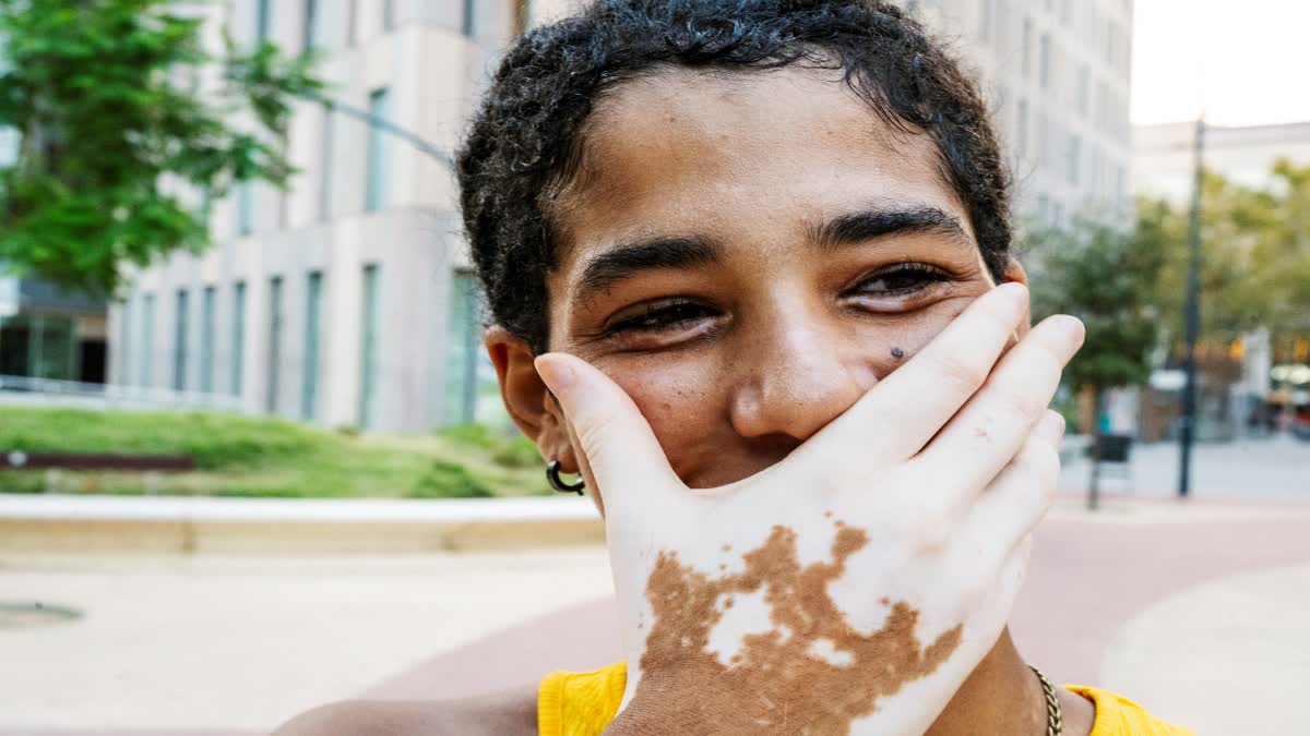 What is the Vitiligo Problem