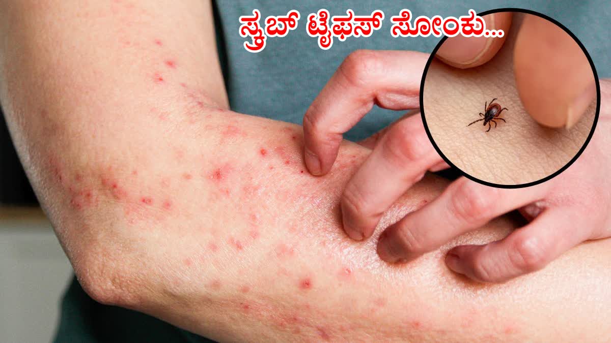 SCRUB TYPHUS  SCRUB TYPHUS SYMPTOMS  Rapidly Spreading Scrub Typhus  ಸ್ಕ್ರಬ್ ಟೈಫಸ್ ಸೋಂಕು