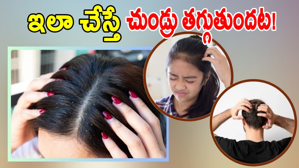 HOW TO TREAT DANDRUFF AT HOME