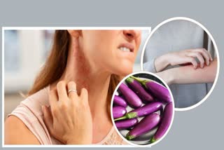 Is Brinjal Can Cause Skin Allergies