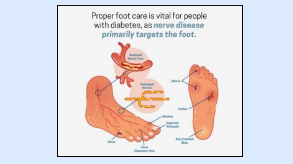Foot Health  For Diabetes Patients