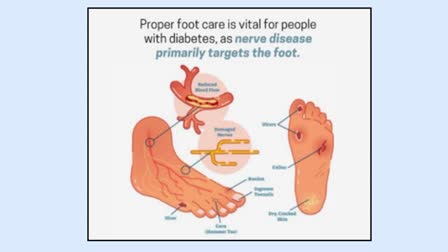 Foot Health  For Diabetes Patients