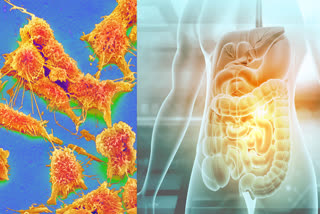 These are some early symptoms of Colon Cancer that you should not ignore