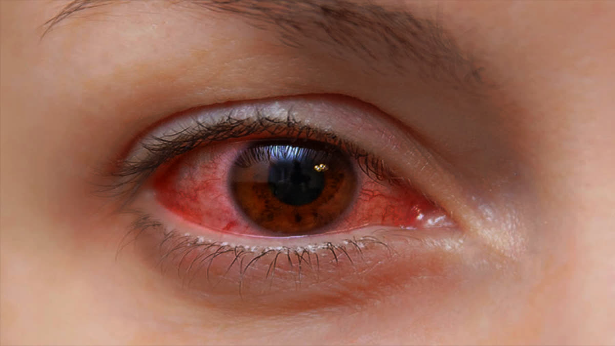 conjunctivitis-precautions-in-telugu