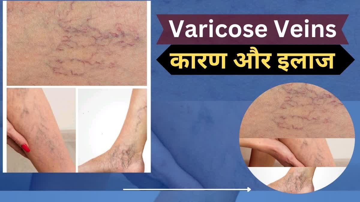 Varicose Veins