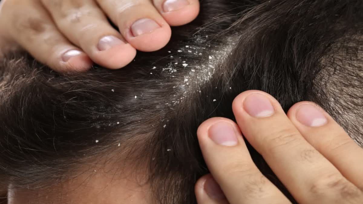 DANDRUFF HOME REMEDIES