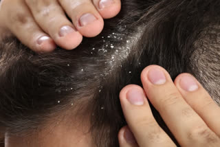 Easy home remedies to remove dandruff from hair