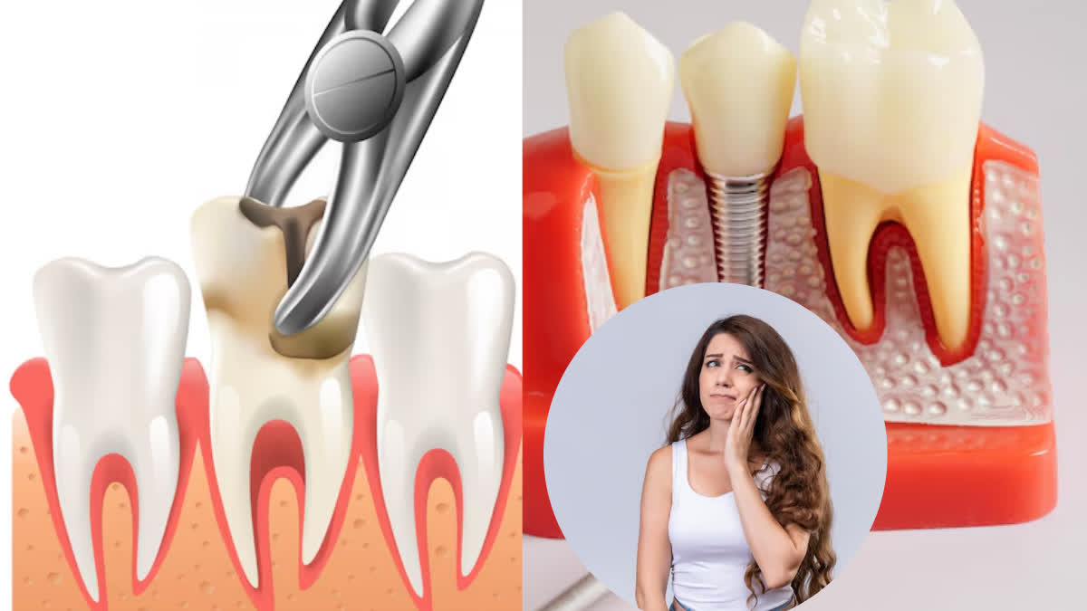 It is important to take special care of your teeth after root canal, know why?