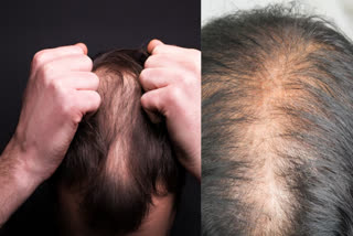 Is iron deficiency causing hair loss among youth? Expert explain