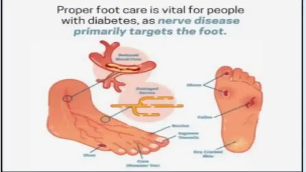 Foot Health For Diabetes Patients