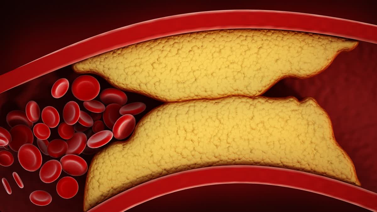 Foot Pain is a Sign of Cholesterol