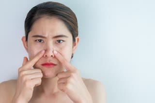 How to Remove Blackheads on the Face