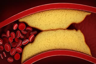 Foot Pain is a Sign of Cholesterol