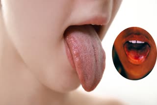 جانئے زبان کا کینسر کتنا خطرناک ہے، یہ کیسے ہوتا ہے اور اس کی علامات کیا ہیں۔