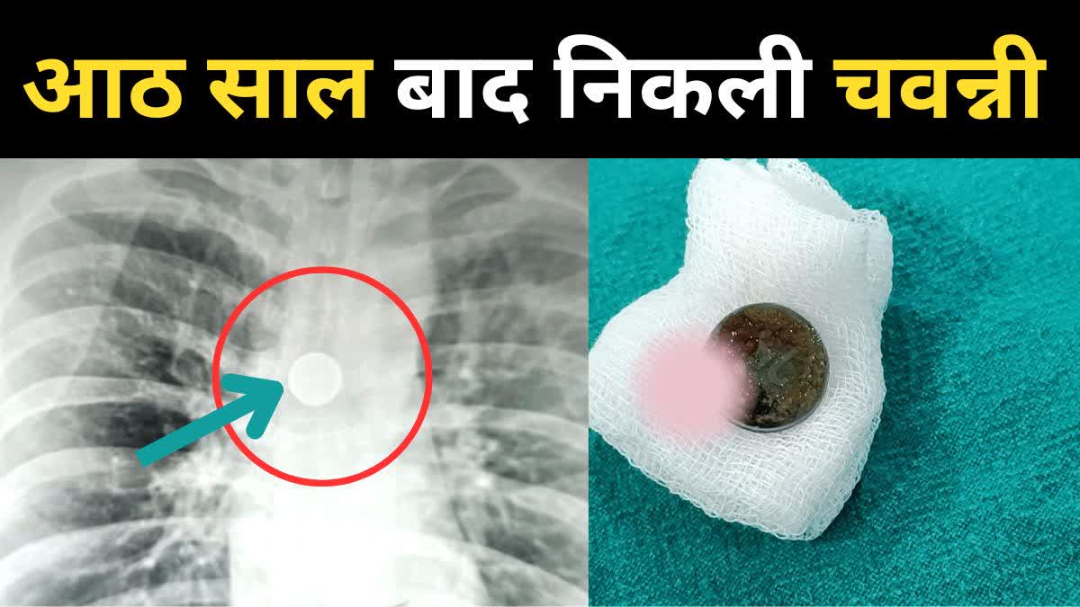 25 paise coin swallowed by patient 8 years ago was removed through surgery at bhu uttar pradesh news today