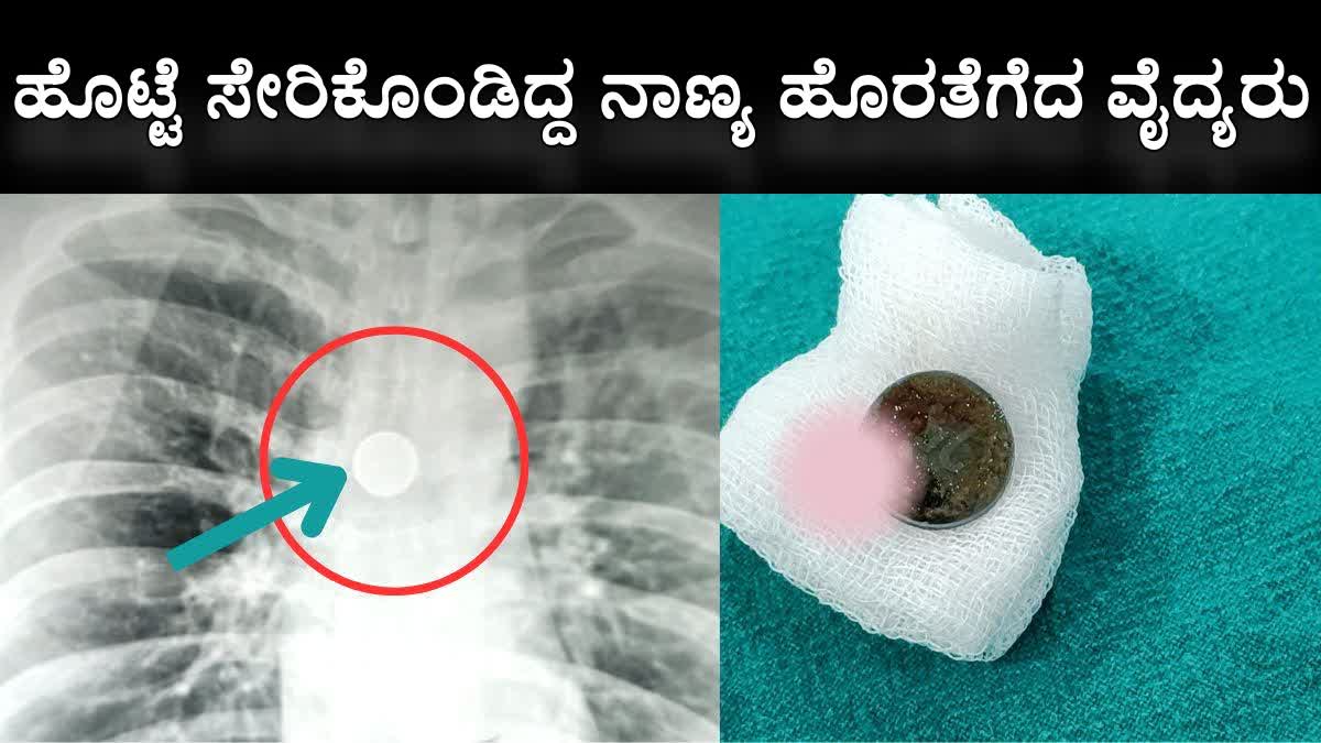 25 PAISE COIN SWALLOWED PATIENT