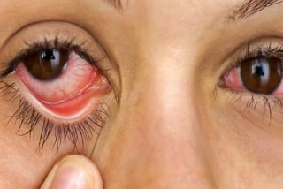 Eye Flu In Himachal, 500 eye flu cases in hamirpur