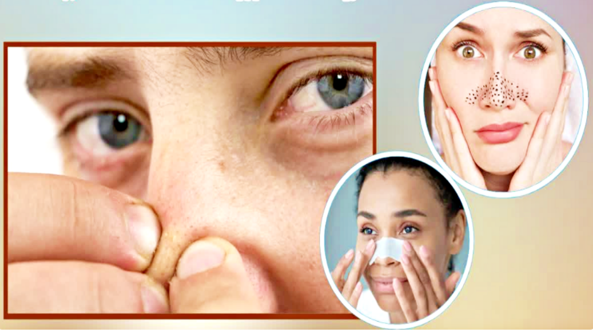 BLACKHEADS REMOVAL REMEDIES AND AND REMOVE BLACKHEADS NATURALLY AT HOME