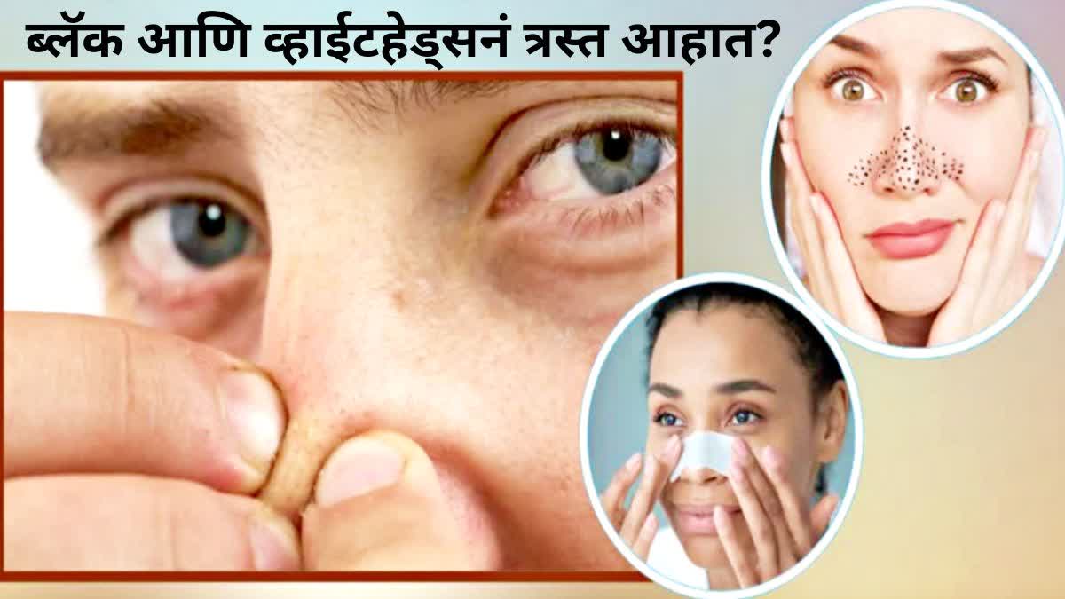 Remedies To Remove Blackheads