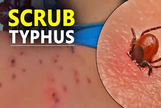 Scrub Typhus in Himachal