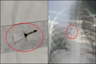 ബ്രോങ്കോസ്കോപ്പി  Bronchoscopy  Pin Caught In Lung  RIMs Doctors Removed Through Bronchoscopy  Bronchoscopy Treatment  ബെംഗളൂരു വാര്‍ത്തകള്‍  കര്‍ണാടക വാര്‍ത്തകള്‍  കര്‍ണാടകയിലെ പുതിയ വാര്‍ത്തകള്‍