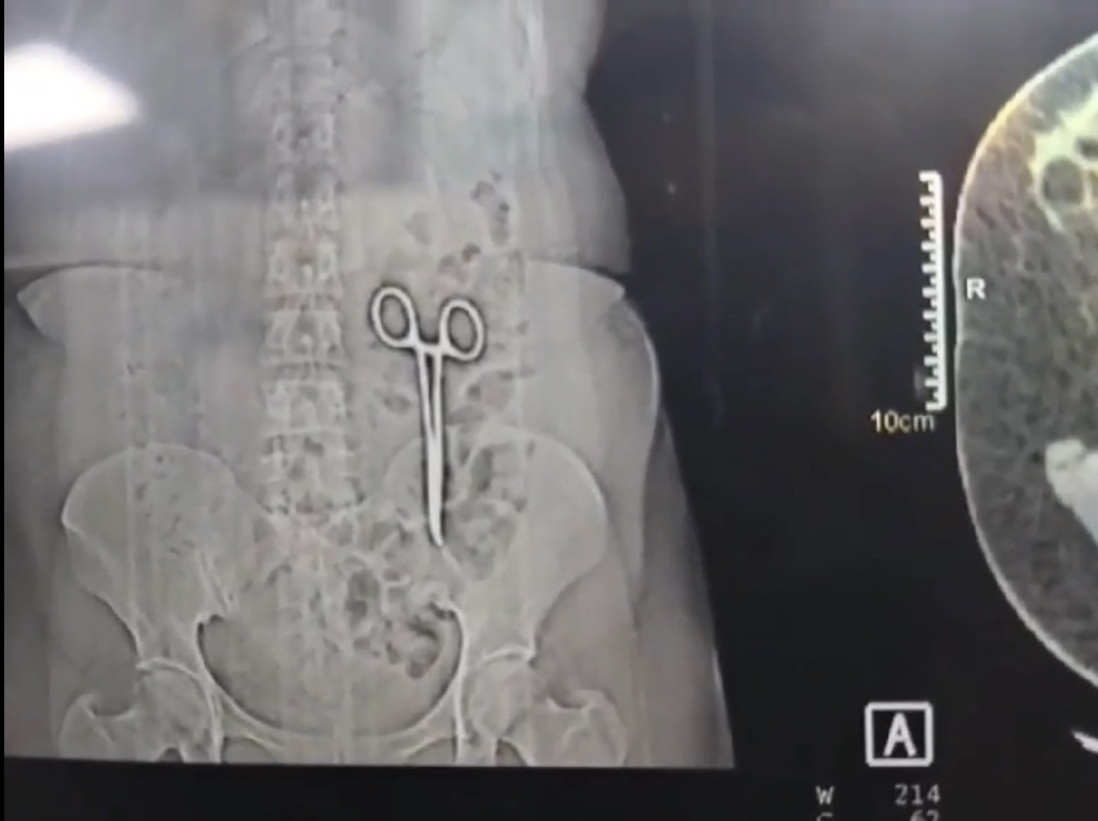 SCISSORS forcep IN THE STOMACH