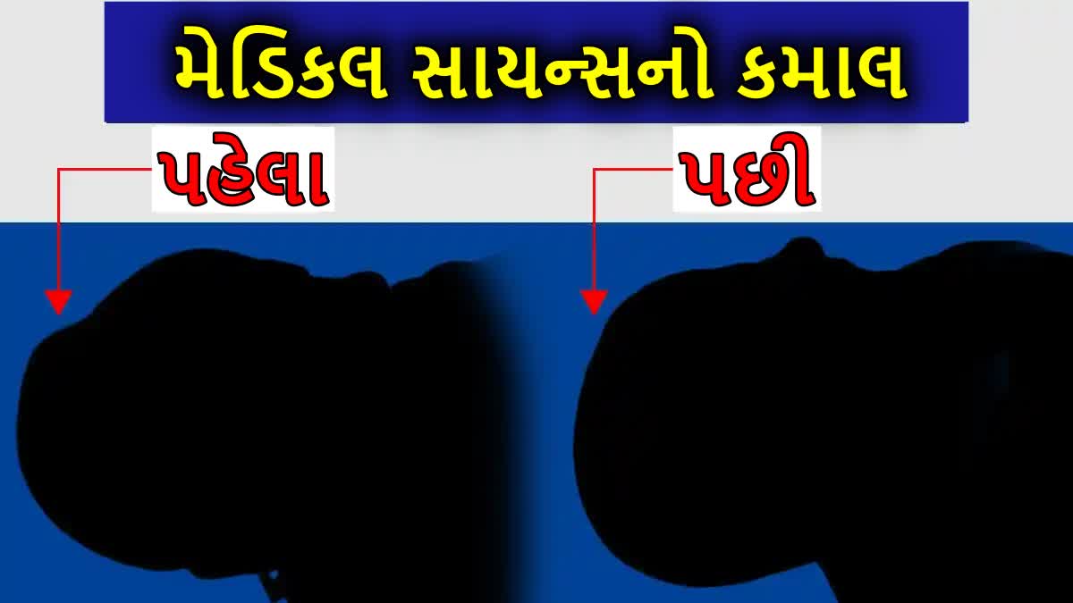 AIIMS ઋષિકેશમાં બાળકના શિશને મળ્યો નવો આકાર