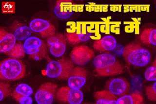 आयुर्वेदिक पद्धति से लिवर कैंसर का इलाज संभव.