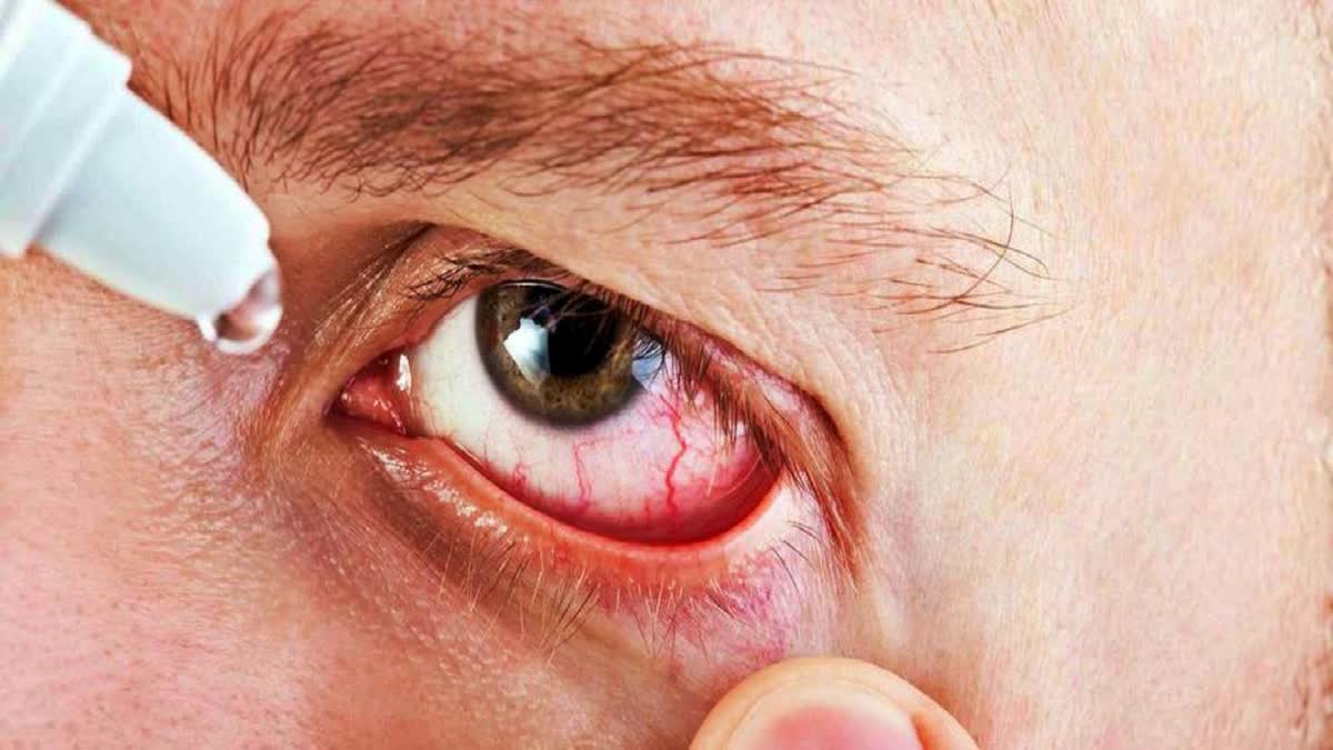 Eye Flu Cases In Hamirpur