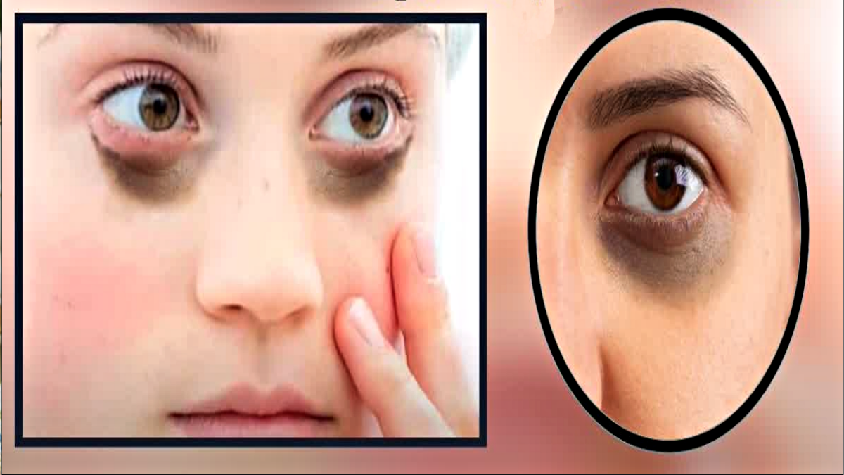 EYE DARK CIRCLES REASON AND EYE DARK CIRCLES REMOVAL REMEDIES TREATMENT