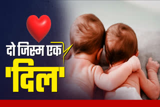 SHAHDOL CONJOINED TWINS