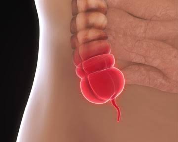 WHAT IS APPENDICITIS  APPENDICITIS TREATMENT  അപ്പെന്‍ഡിസൈറ്റിസ് ലക്ഷണം  അപ്പെന്‍ഡിസൈറ്റിസ് ചികിത്സ