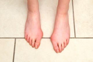 Swelling in the Toes