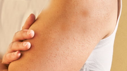 Keratosis Pilaris Causes