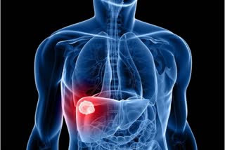 control-of-liver-cancer-with-immunotherapy-says-new-study