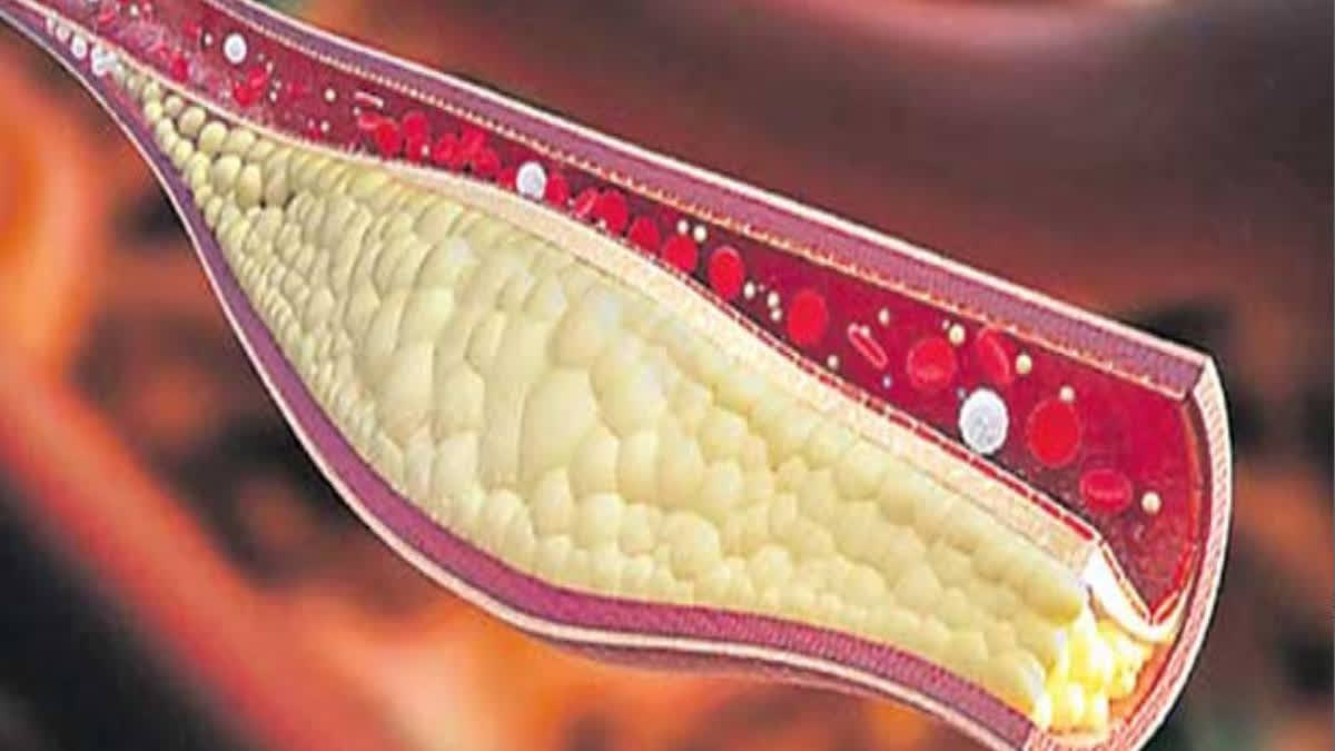 csi-issued-indian-guidelines-for-dyslipidemia-management