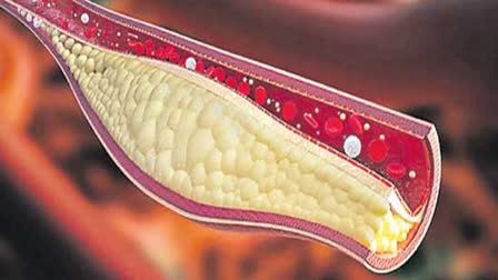 CARDIOLOGICAL SOCIETY OF INDIA  BLOOD CHOLESTEROL LEVELS  HEART ATTACK AND STROKE  രക്തത്തിലെ കൊളസ്‌ട്രോൾ