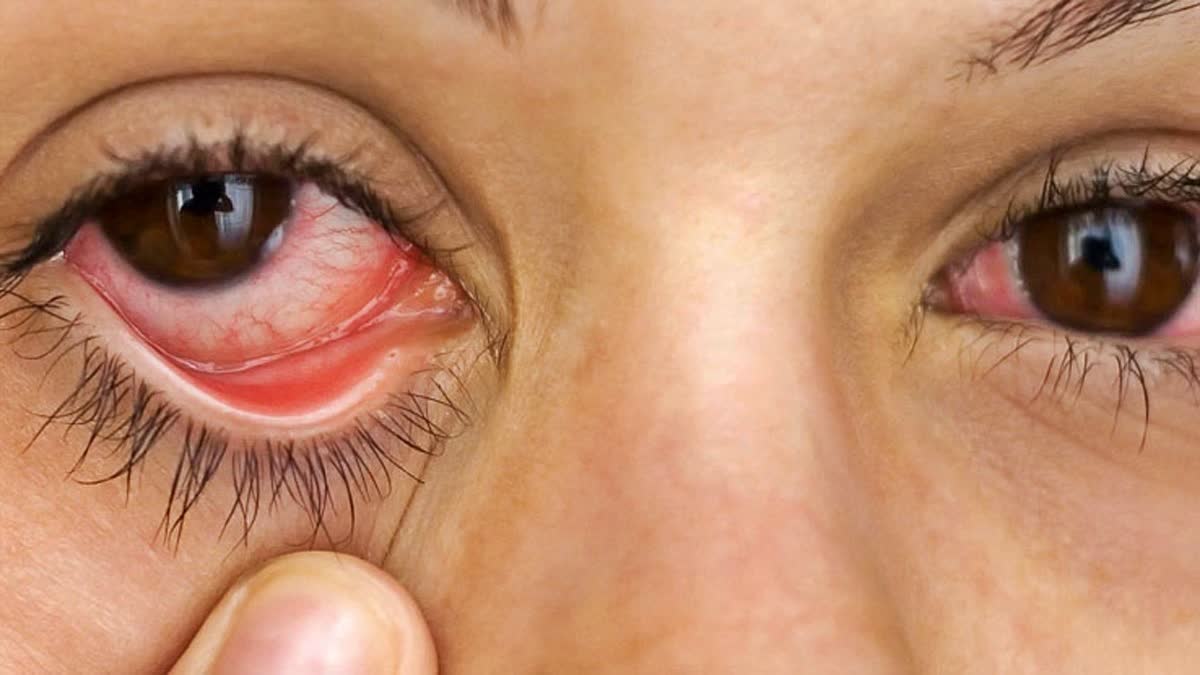 Eye Flu Cases In Hamirpur