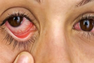 Eye Flu Cases In Hamirpur