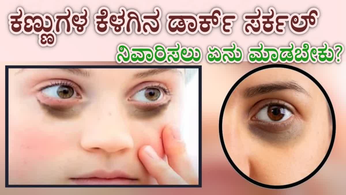 DARK CIRCLES REASON AND REMEDY  DARK CIRCLES HOME REMEDIES  DARK CIRCLES REASON  DARK CIRCLES TREATMENT AT HOME