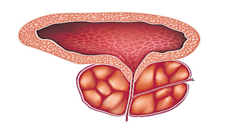 dont-neglect-prostate-enlargement-symptoms