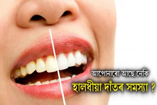 How to Get Rid of Yellow Teeth: 5 Home Remedies