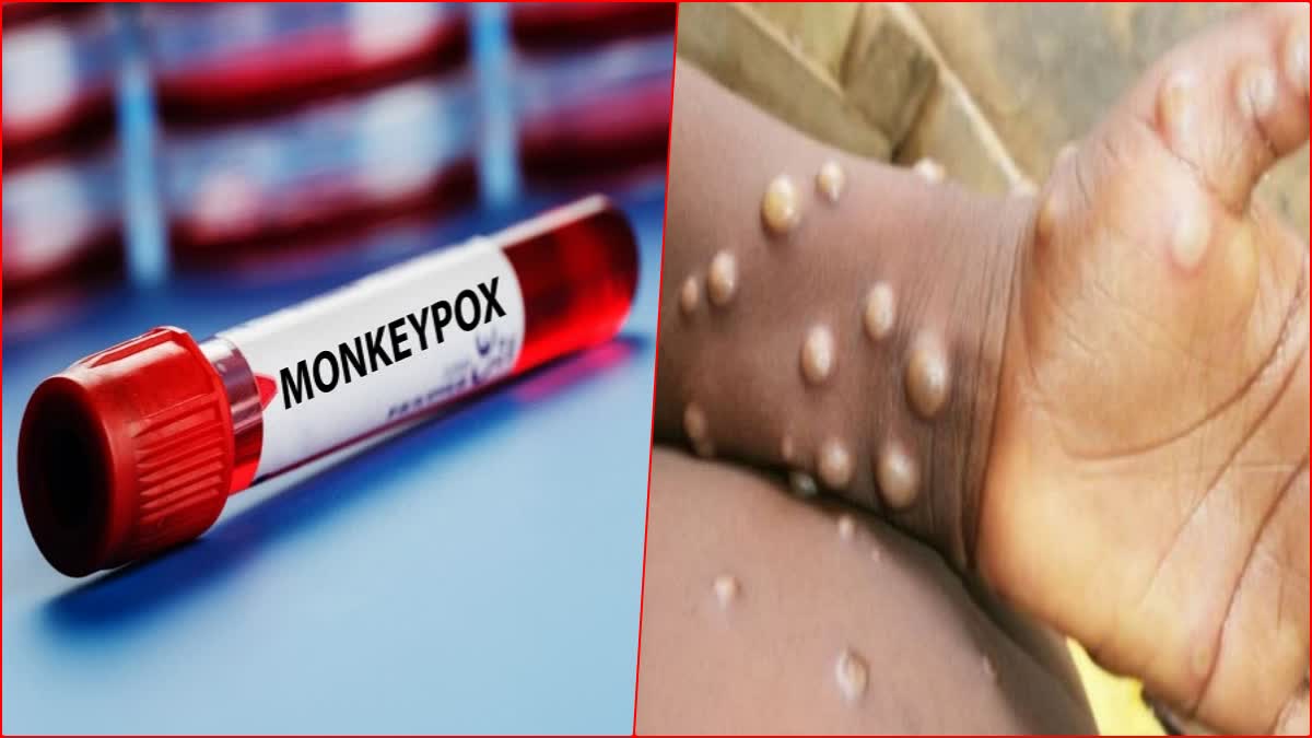 Monkeypox Virus Alert in Himachal