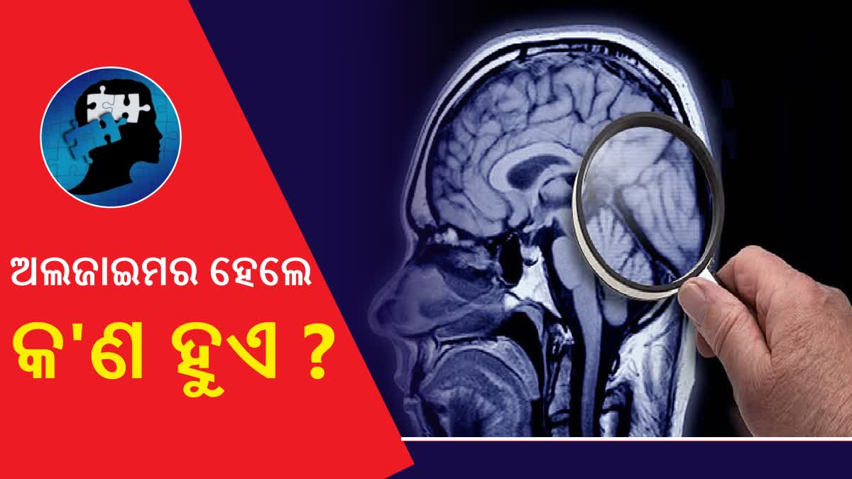 ମୁଣ୍ଡରେ ହେଉଥିବା ଅଲଜାଇମର କ'ଣ ? ଏହି ରୋଗ ହେଲେ କ'ଣ ହୁଏ