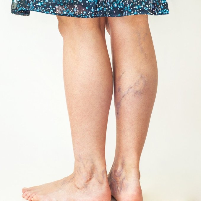 Varicose Veins Problems