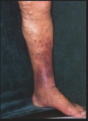 Varicose Veins Problem